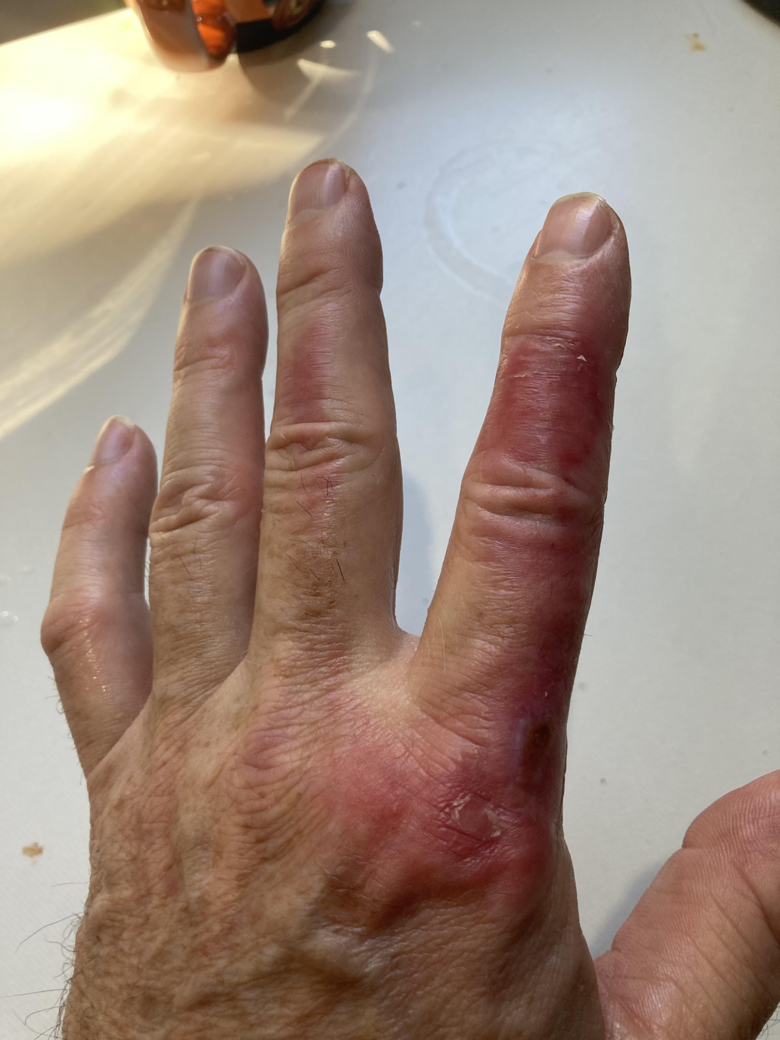 Severe electrical arc burn injury